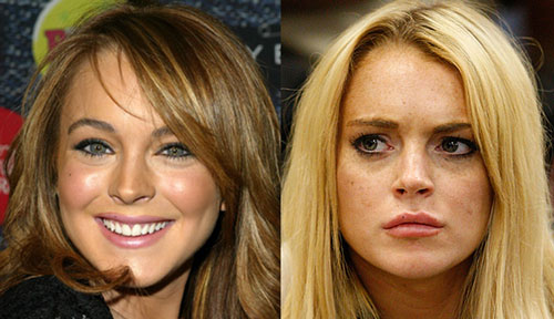 lindsay lohan plastic surgery before and after